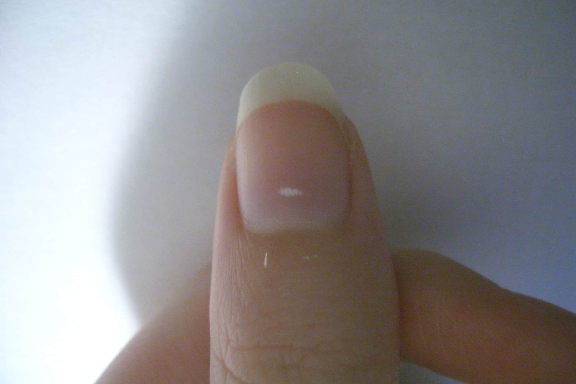 Что означают белые пятна на ногтях рук. Поперечная лейконихия. Лейконихия продольная. Лейконихия (белые пятнышки).